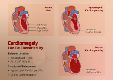 Heart enlargement (cardiomegaly)